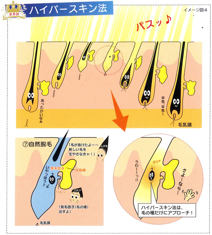 ハイパースキン脱毛の脱毛理論を解説したイラスト画像