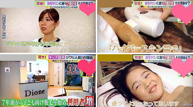 ハイパースキン脱毛がテレビ取材を受けた実績の写真